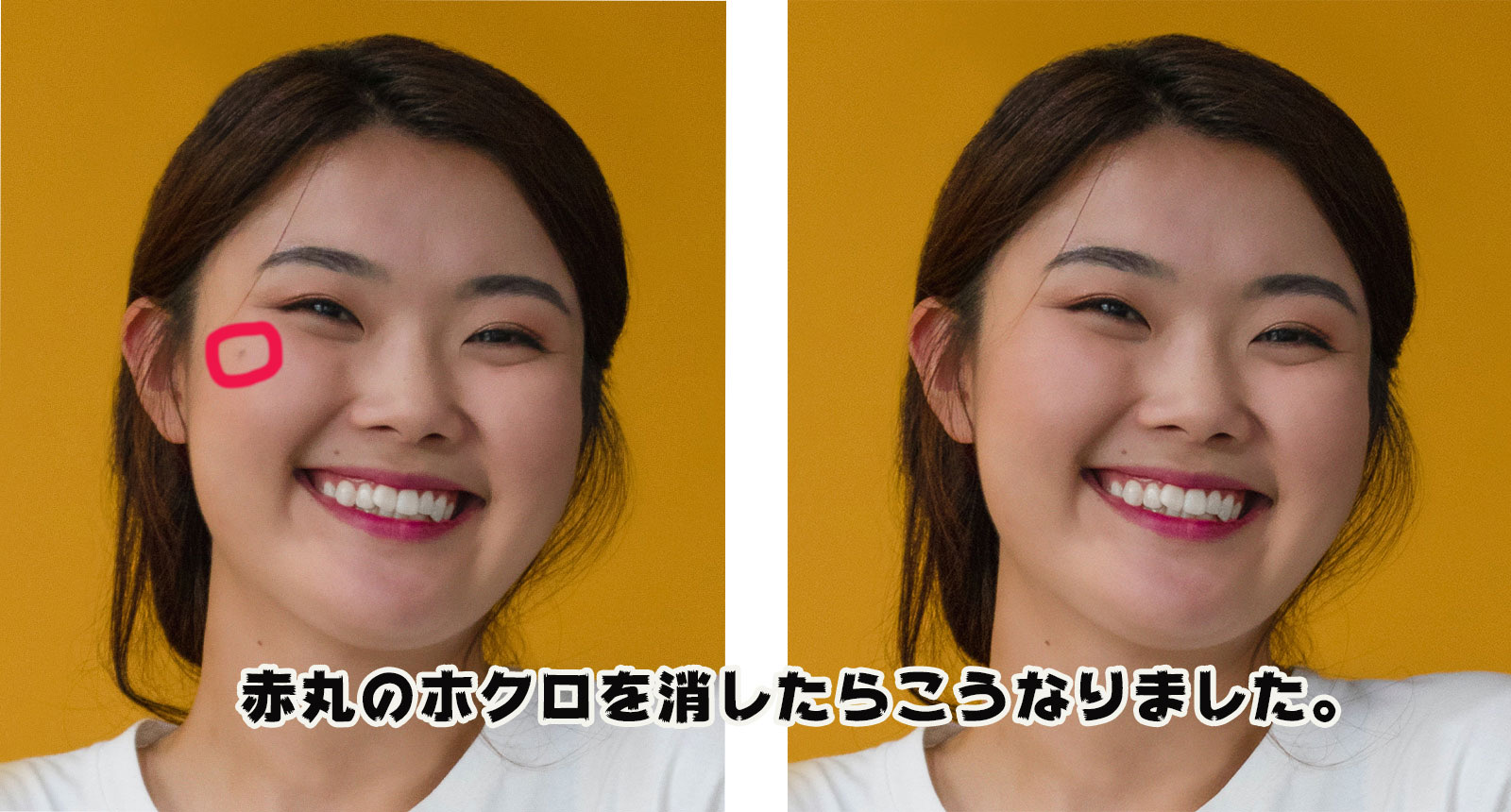 顔のほくろ除去のビフォーアフター